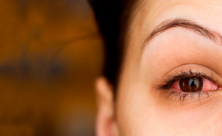 Conjuntivitis
